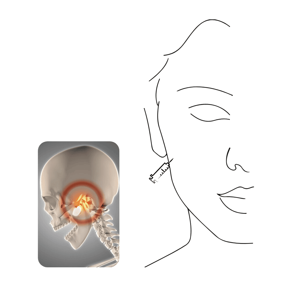 Anatomisches Bild eines Schädels mit Schmerzpunkt und Nadel.