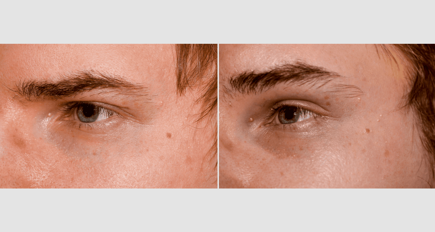 Vergleich der Haut um die Augen mit und ohne Hautpflege.