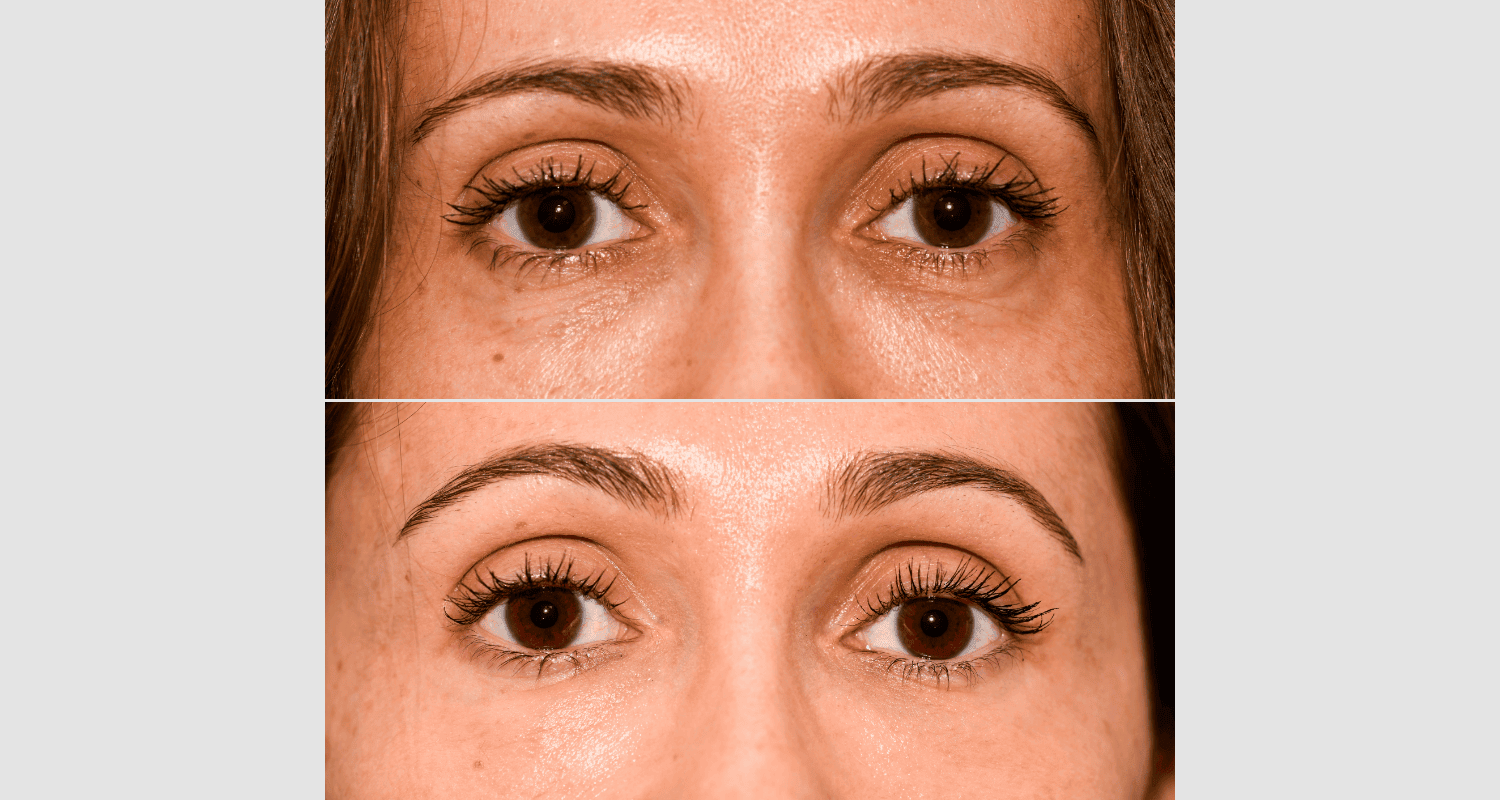 Nahaufnahme von Augenpartie vor und nach Botox-Behandlung.