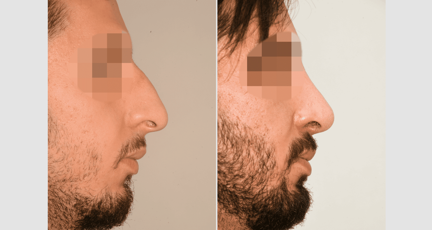 Vorher/Nachher Ergebnis: Bilder Nasenkorrektur