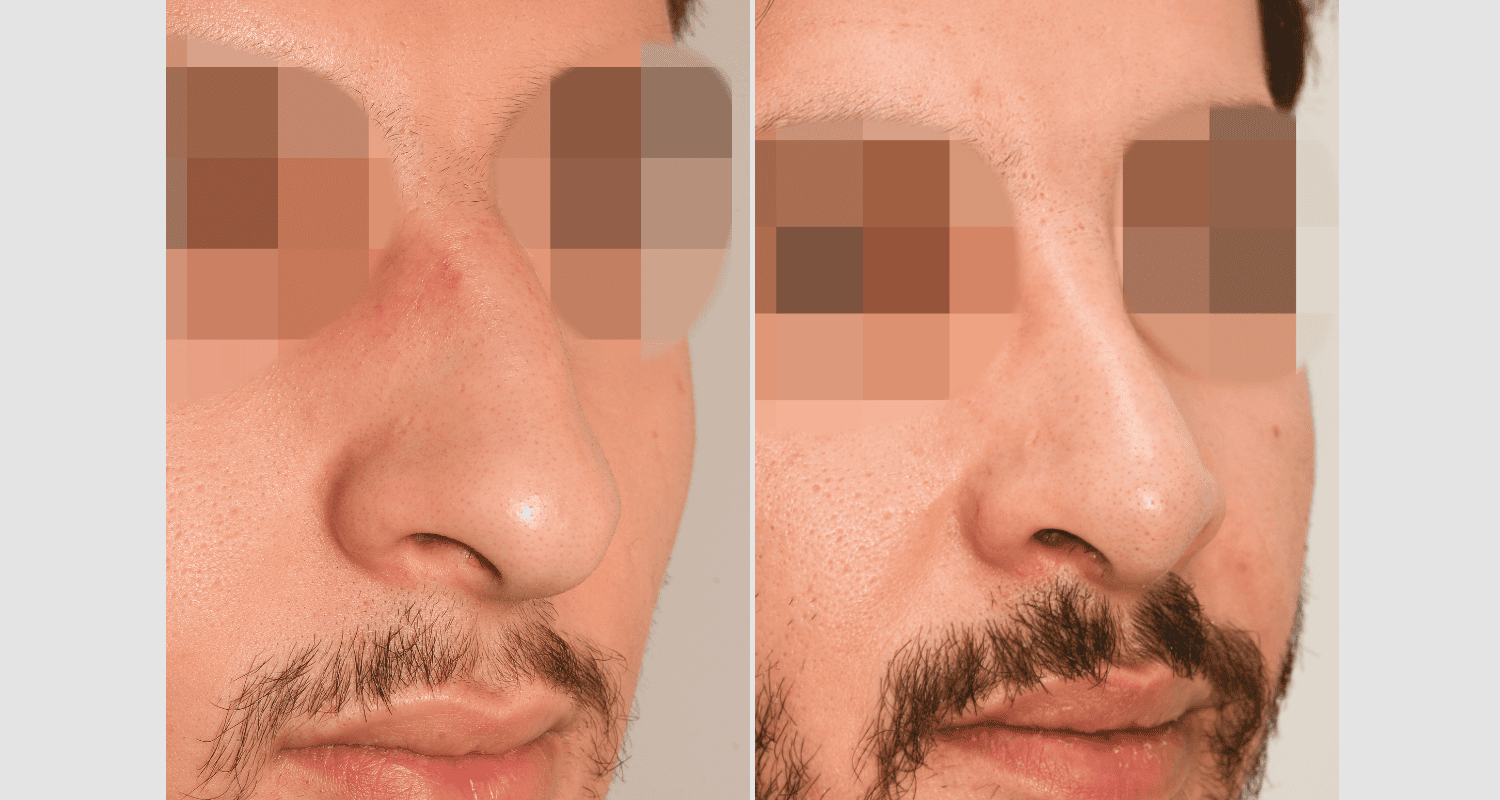 Vorher/Nachher Ergebnis: Bilder Nasenkorrektur