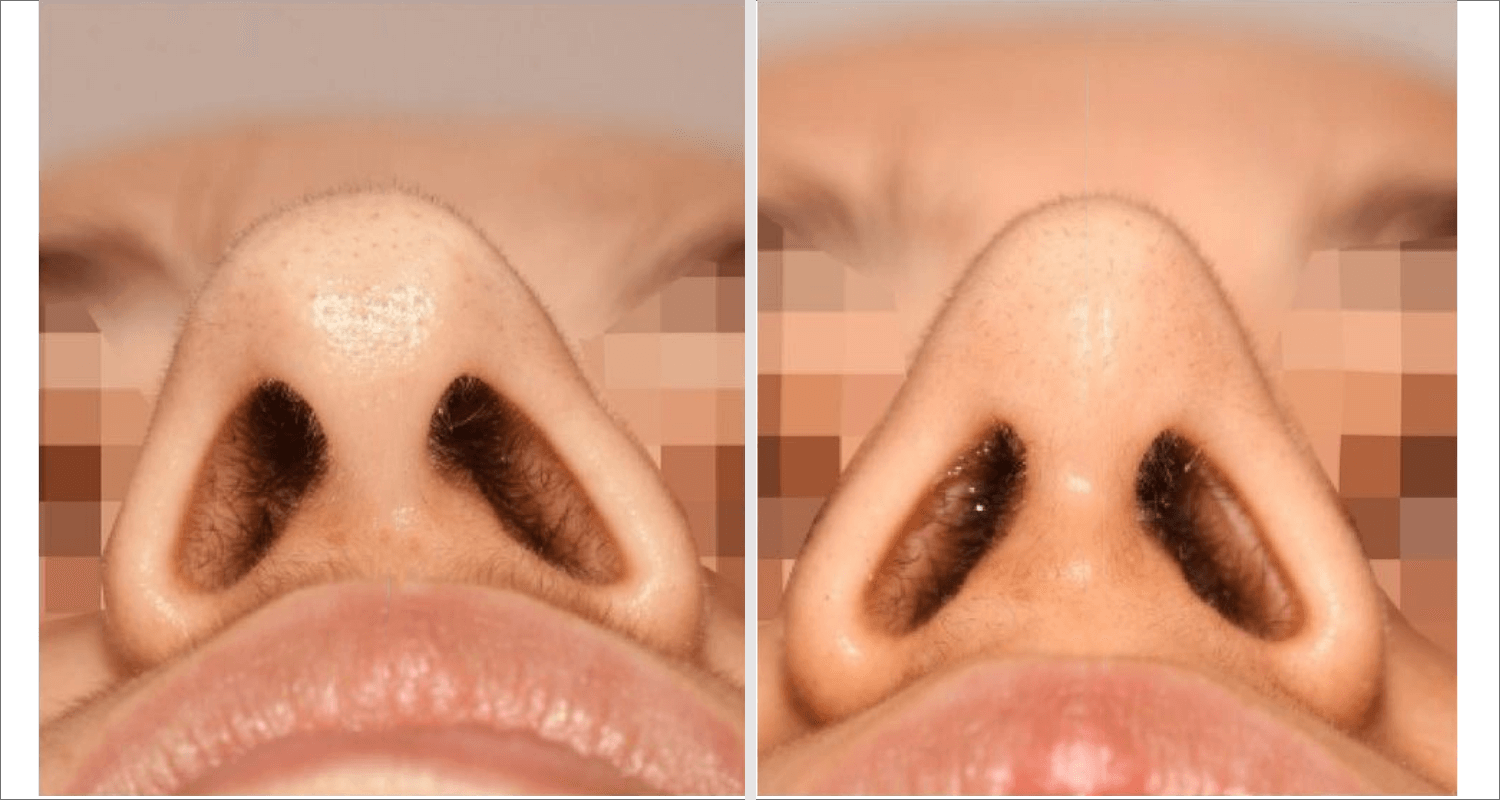 Vorher/Nachher Ergebnis: Bilder Nasenkorrektur