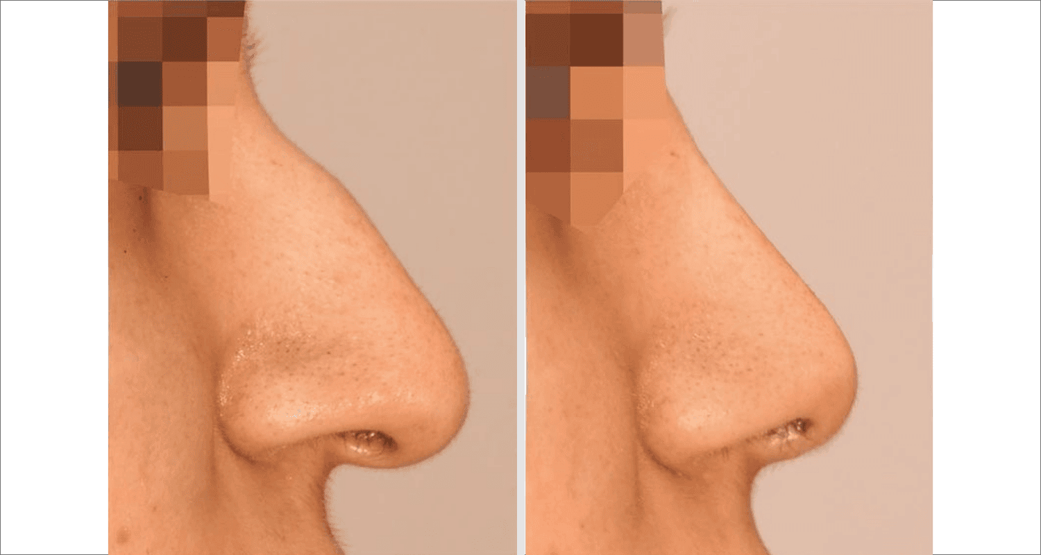 Vorher/Nachher Ergebnis: Bilder Nasenkorrektur