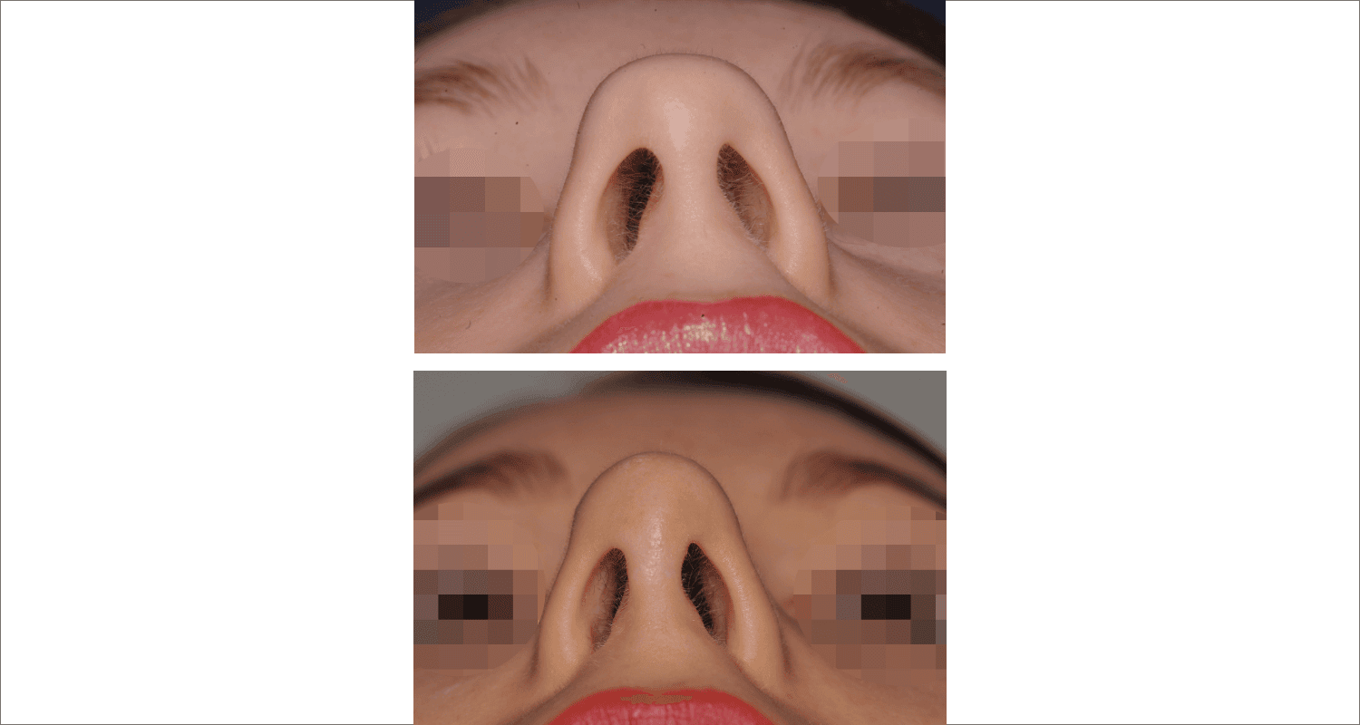 Vorher/Nachher Ergebnis: Bilder Nasenkorrektur