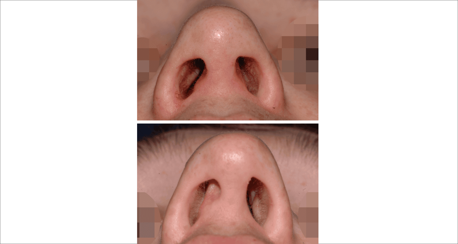 Vorher/Nachher Ergebnis: Bilder Nasenkorrektur
