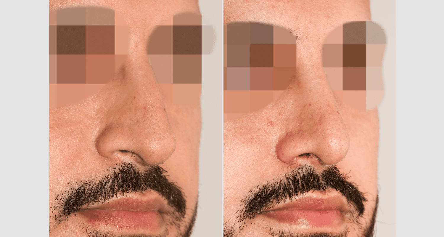 Vorher/Nachher Ergebnis: Bilder Nasenkorrektur