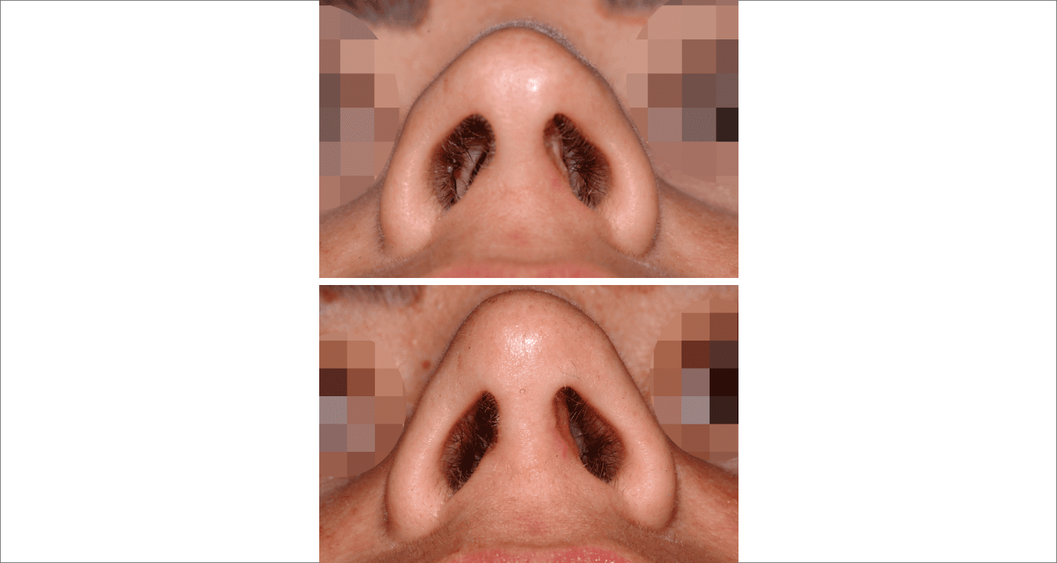 Vorher/Nachher Ergebnis: Bilder Nasenkorrektur