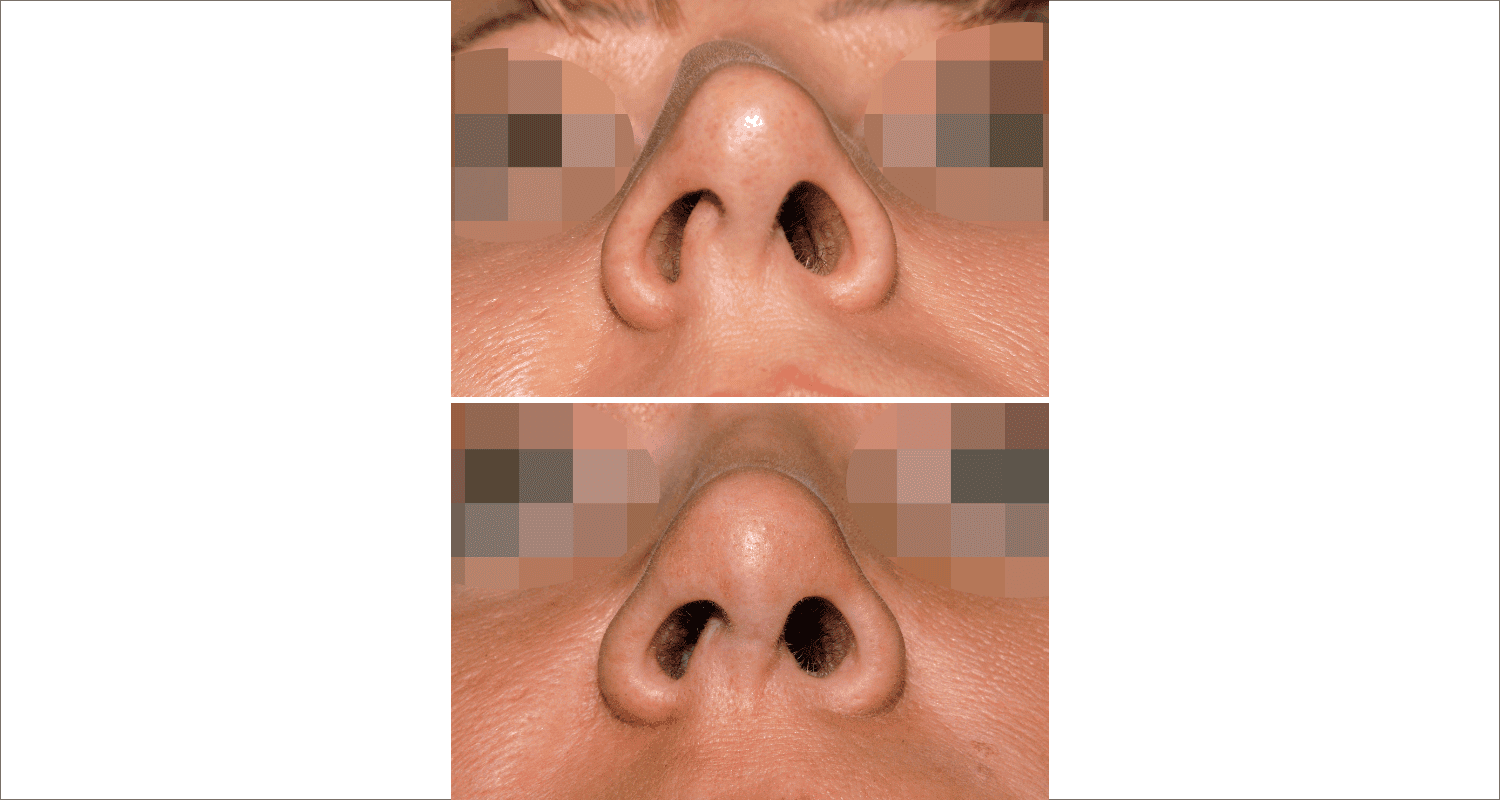 Vorher/Nachher Ergebnis: Bilder Nasenkorrektur