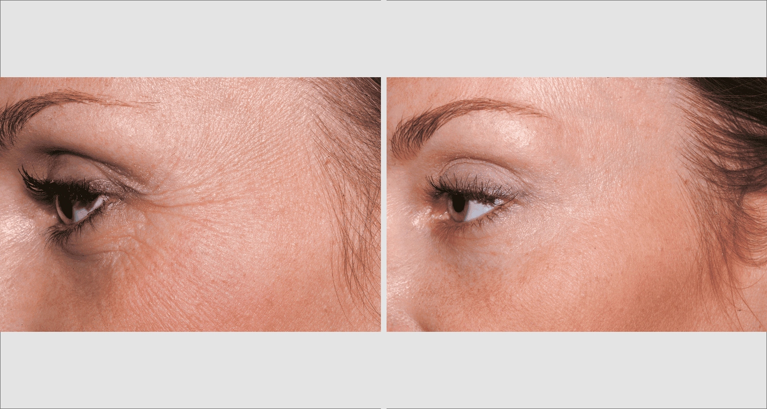Vorher-Nachher Vergleich von Hautverjüngung bei Anti-Aging Behandlung.