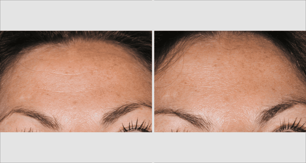 Vorher-Nachher Vergleich der Hautverjüngung mit Mikrodermabrasion.