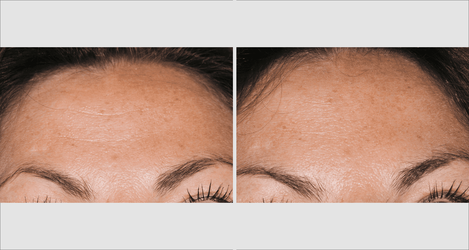 Vorher-Nachher Vergleich der Hautverjüngung mit Mikrodermabrasion.