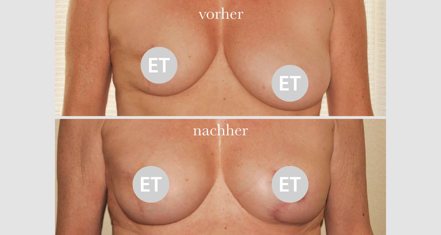 Vorher/Nachher Ergebnis: Brustrekonsturktion