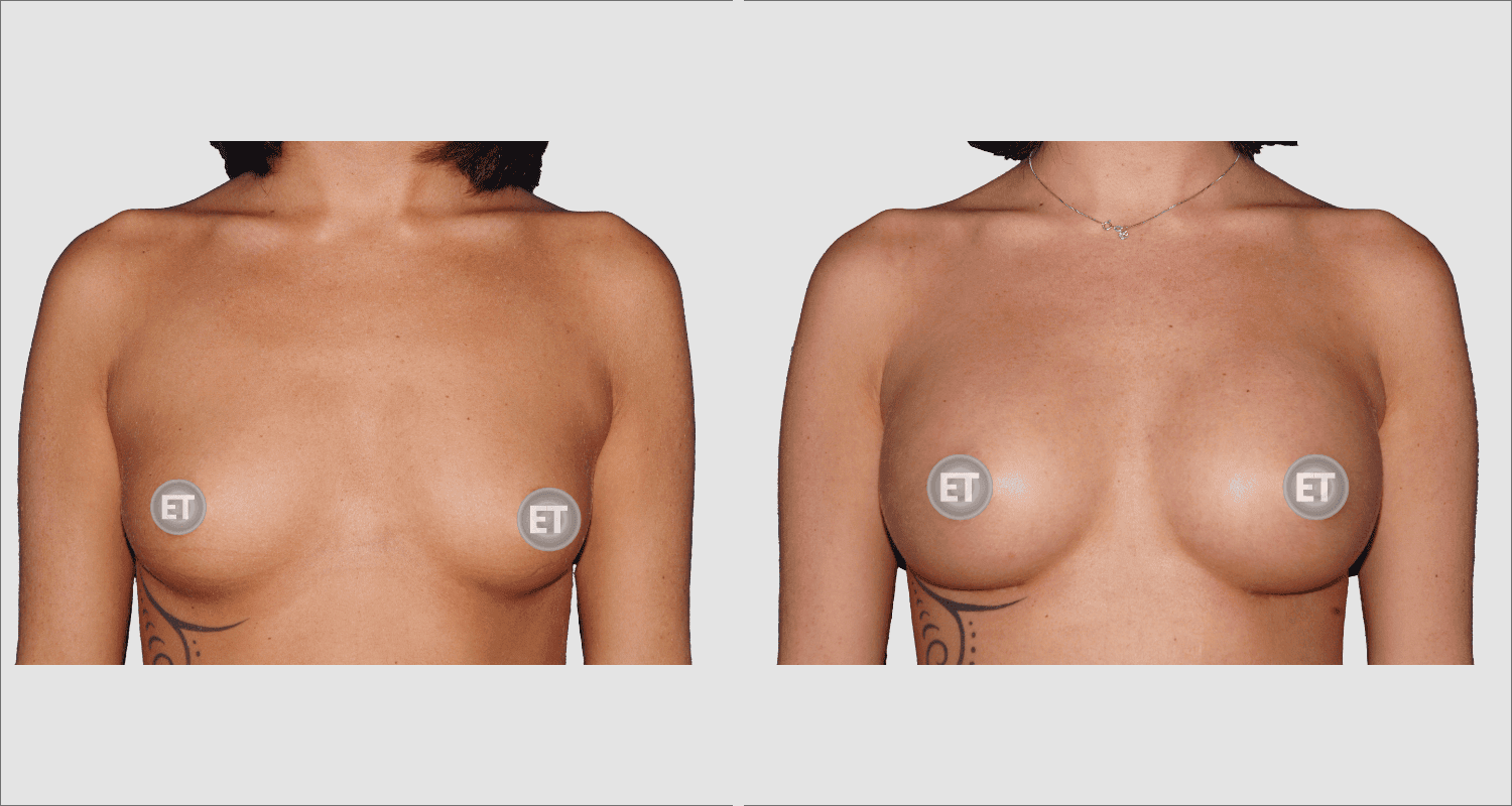 Vorher/Nachher Ergebnis: Brustvergroesserung Mit Implantaten