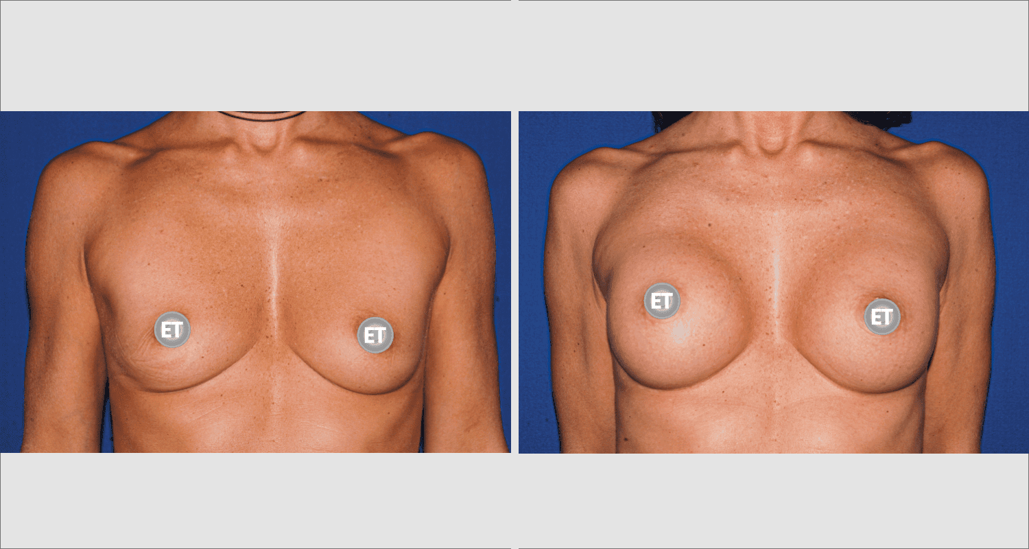 Vorher/Nachher Ergebnis: Brustvergroesserung Mit Implantaten