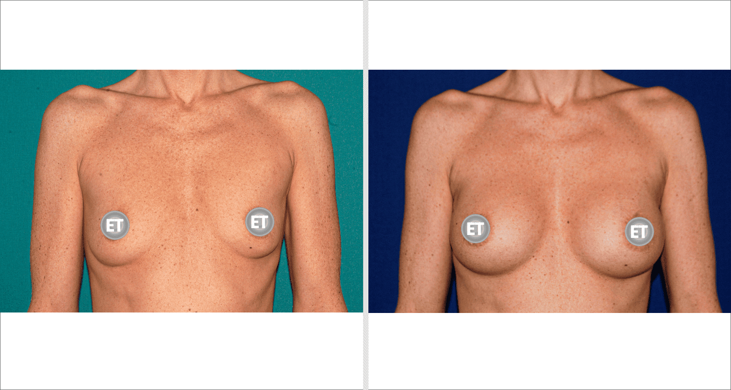 Vorher/Nachher Ergebnis: Brustvergroesserung Mit Implantaten
