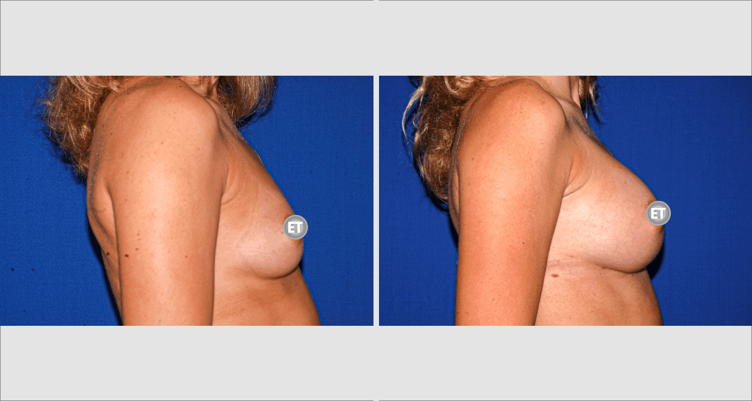 Vorher/Nachher Ergebnis: Brustvergroesserung Mit Implantaten