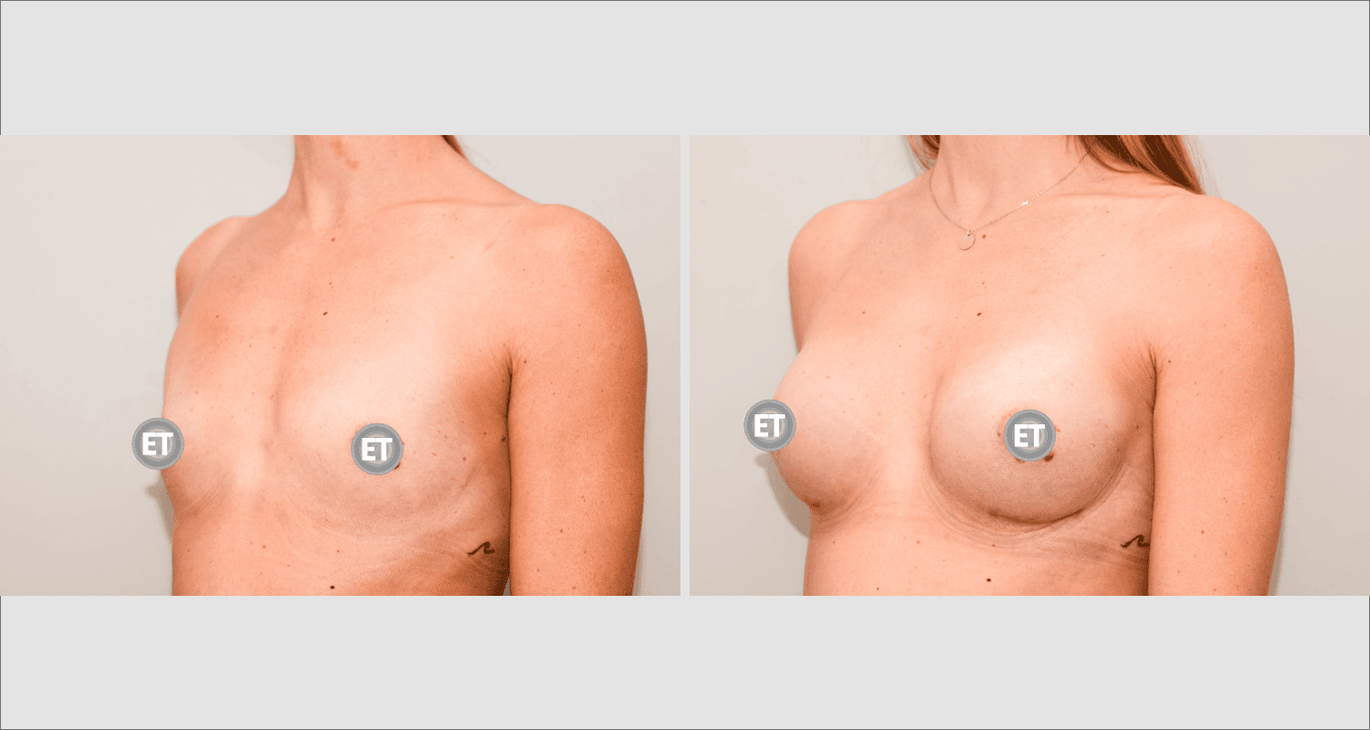 Vorher/Nachher Ergebnis: Brustvergroesserung Mit Implantaten