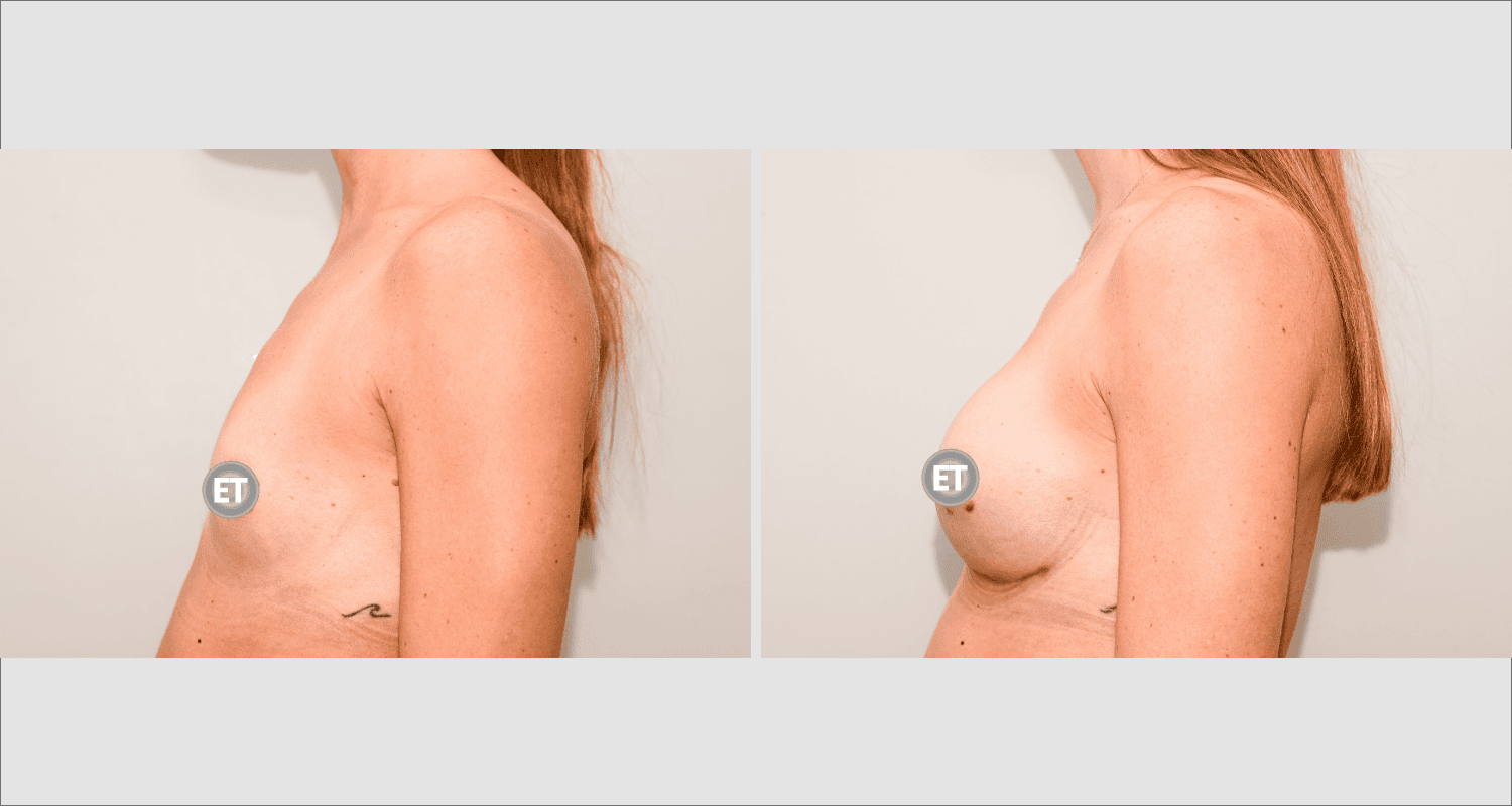 Vorher/Nachher Ergebnis: Brustvergroesserung Mit Implantaten