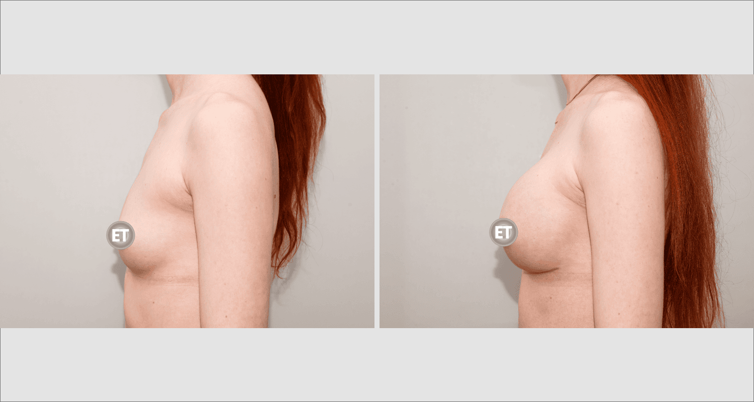 Vorher/Nachher Ergebnis: Brustvergroesserung Mit Implantaten
