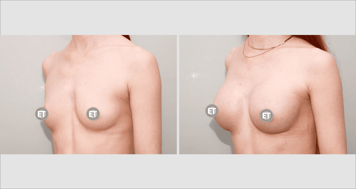 Vorher/Nachher Ergebnis: Brustvergroesserung Mit Implantaten