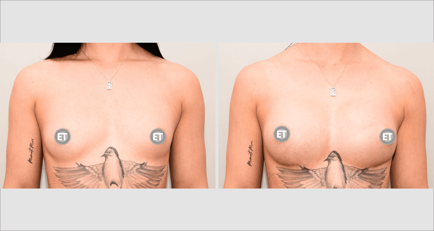 Vorher/Nachher Ergebnis: Brustvergroesserung Mit Implantaten