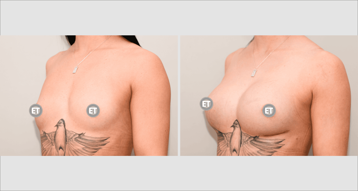 Woman's chest before and after breast augmentation with implants.