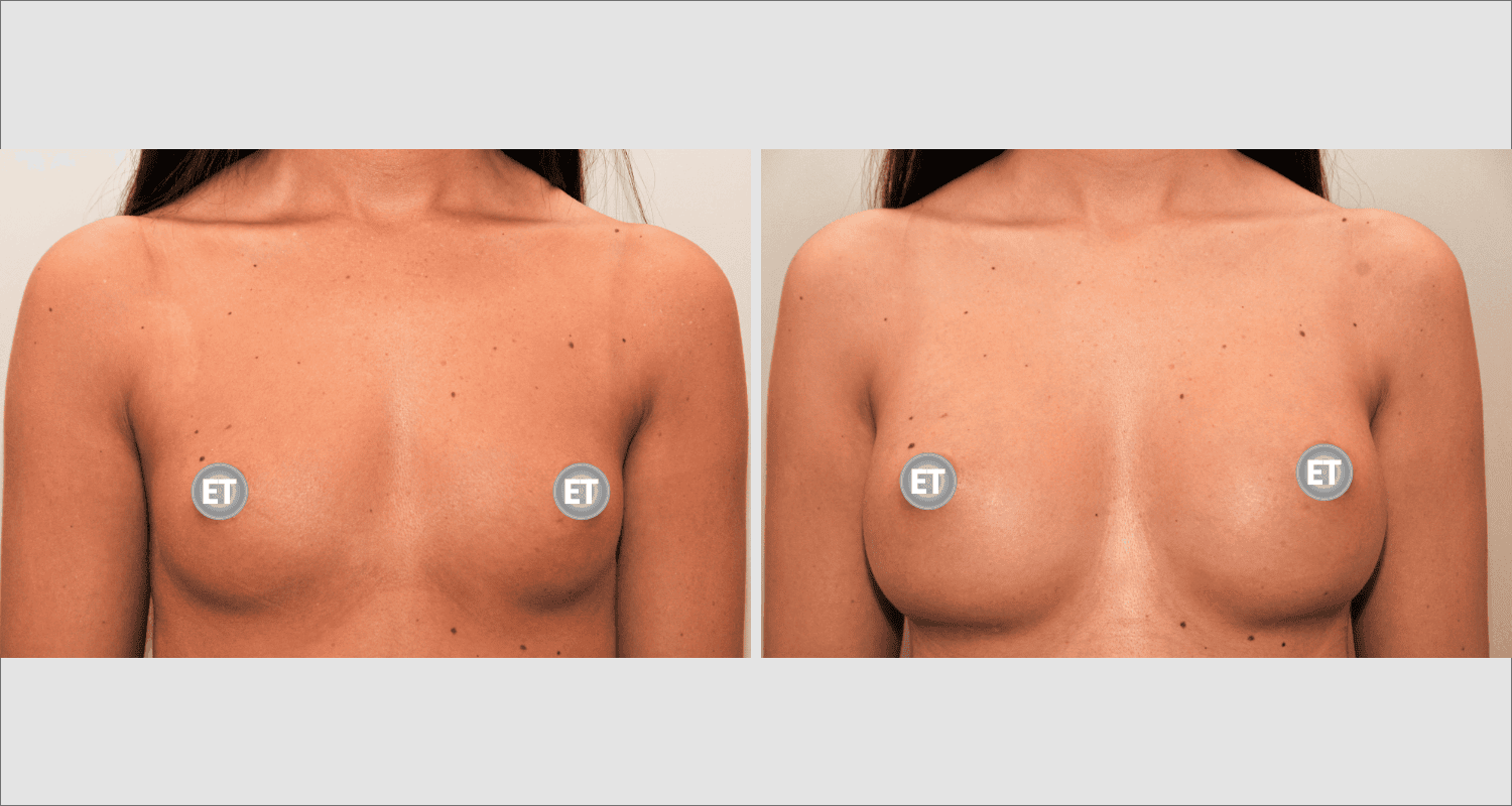 Vorher/Nachher Ergebnis: Brustvergroesserung Mit Implantaten