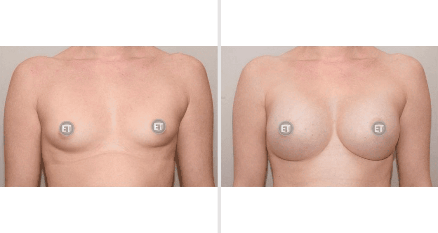 Vorher/Nachher Ergebnis: Brustvergroesserung Mit Implantaten