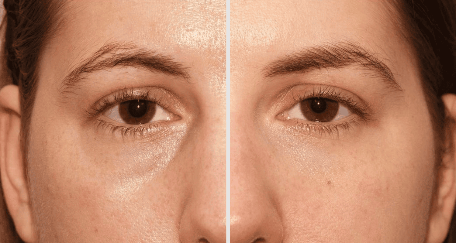 Vorher/Nachher Ergebnis: Eigenfett Augenringe