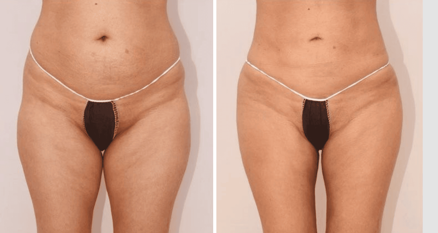 Vorher und Nachher Bilder einer Eigenfetttransplantation im Bauchbereich.