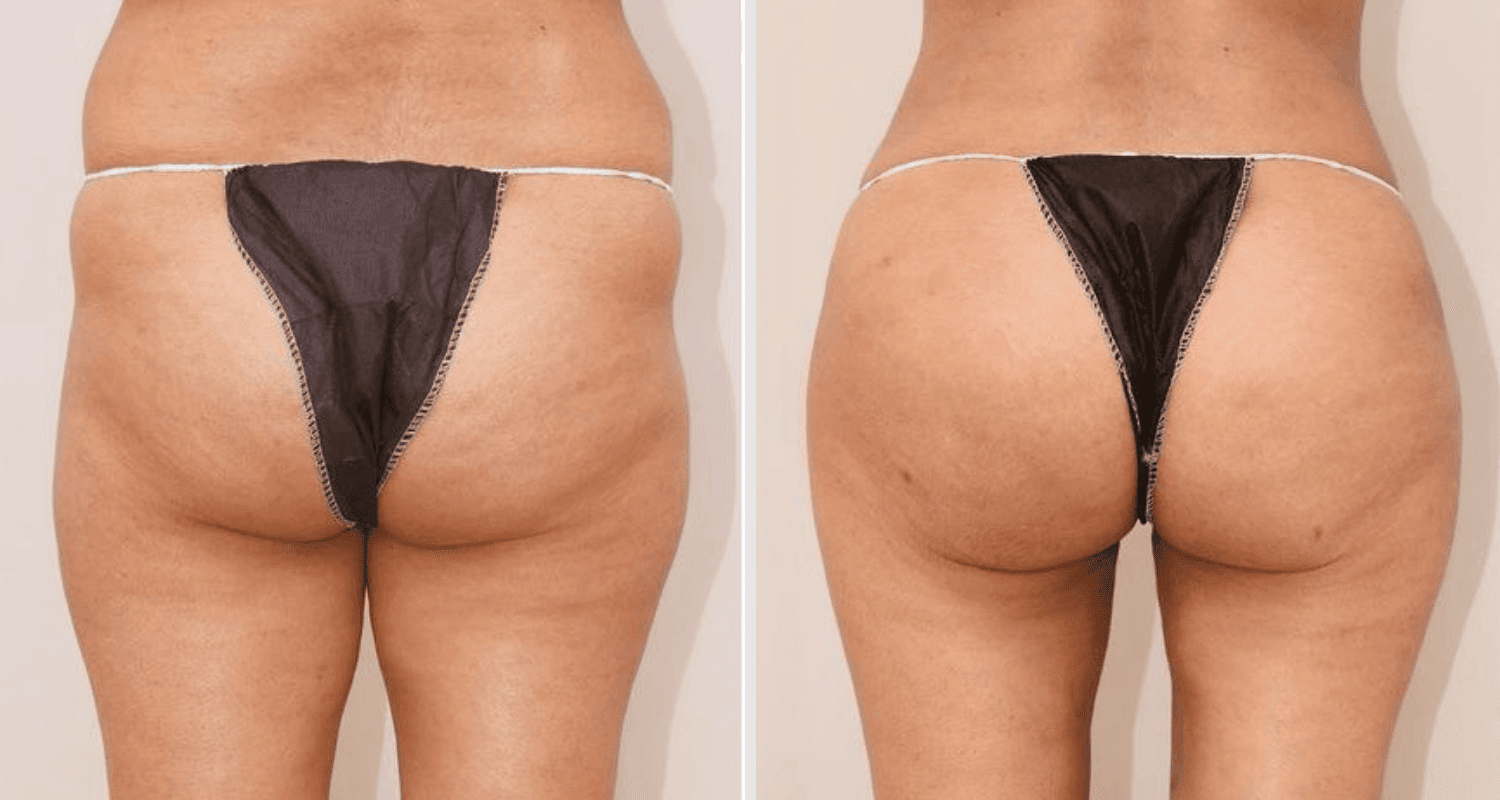 Vorher/Nachher Ergebnis: Eigenfett Bodyforming