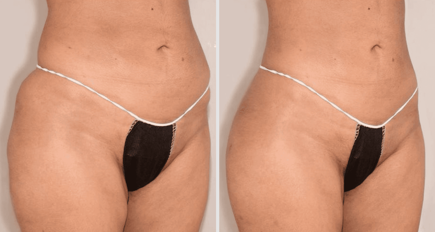 Vorher/Nachher Ergebnis: Eigenfett Bodyforming
