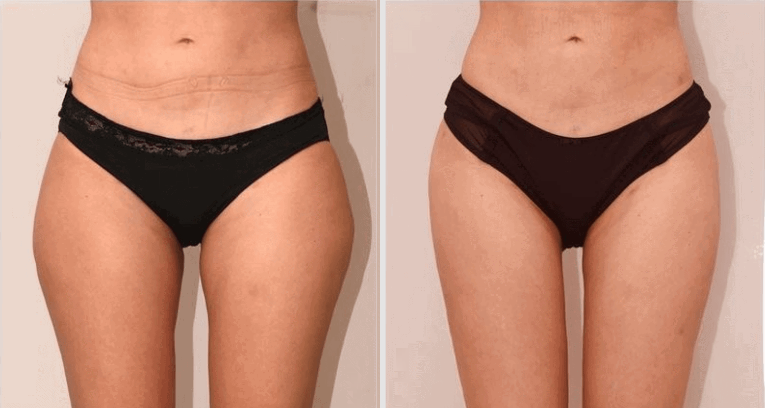 Vorher/Nachher Ergebnis: Eigenfett Bodyforming
