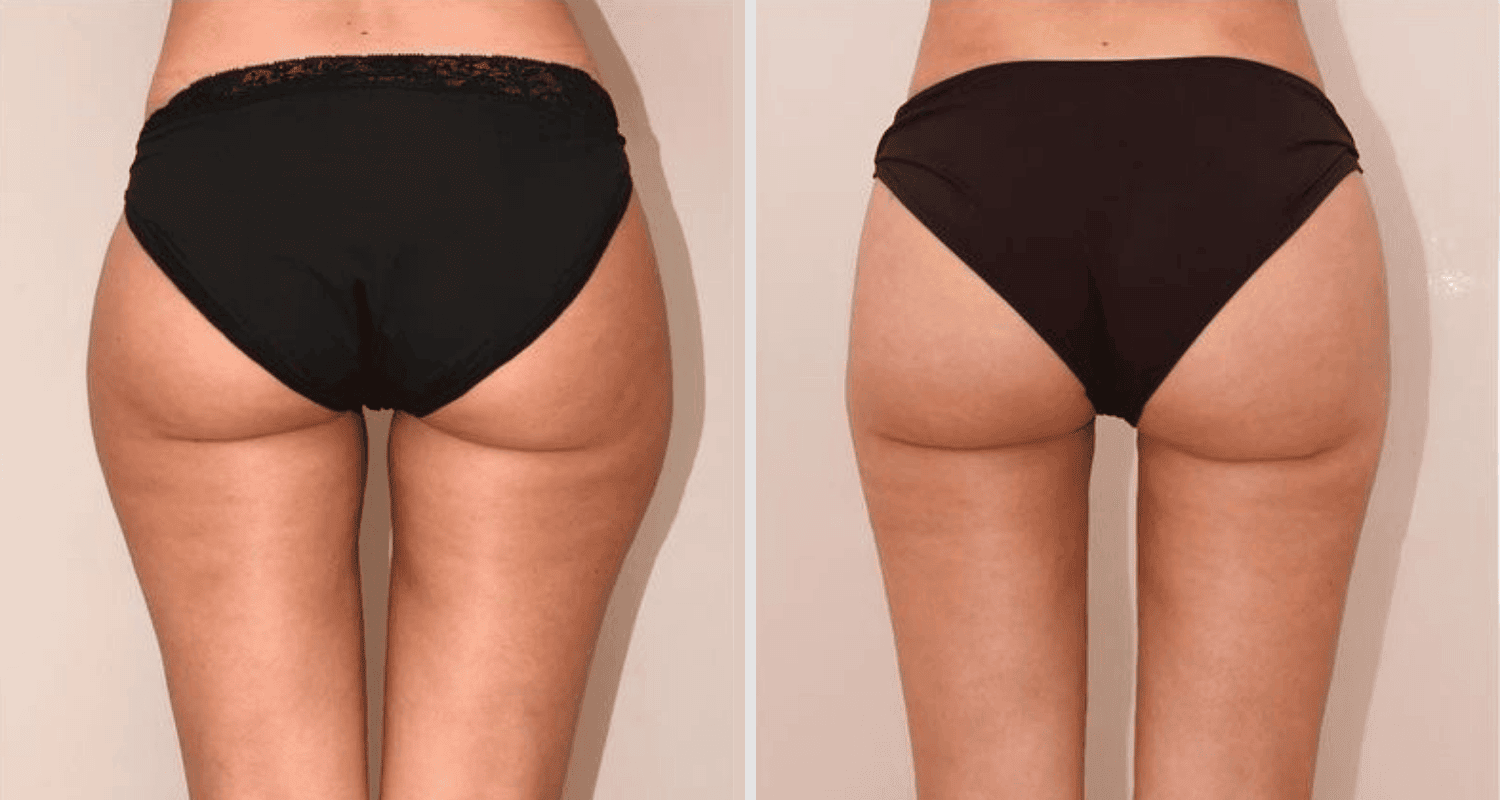 Vorher/Nachher Ergebnis: Eigenfett Bodyforming