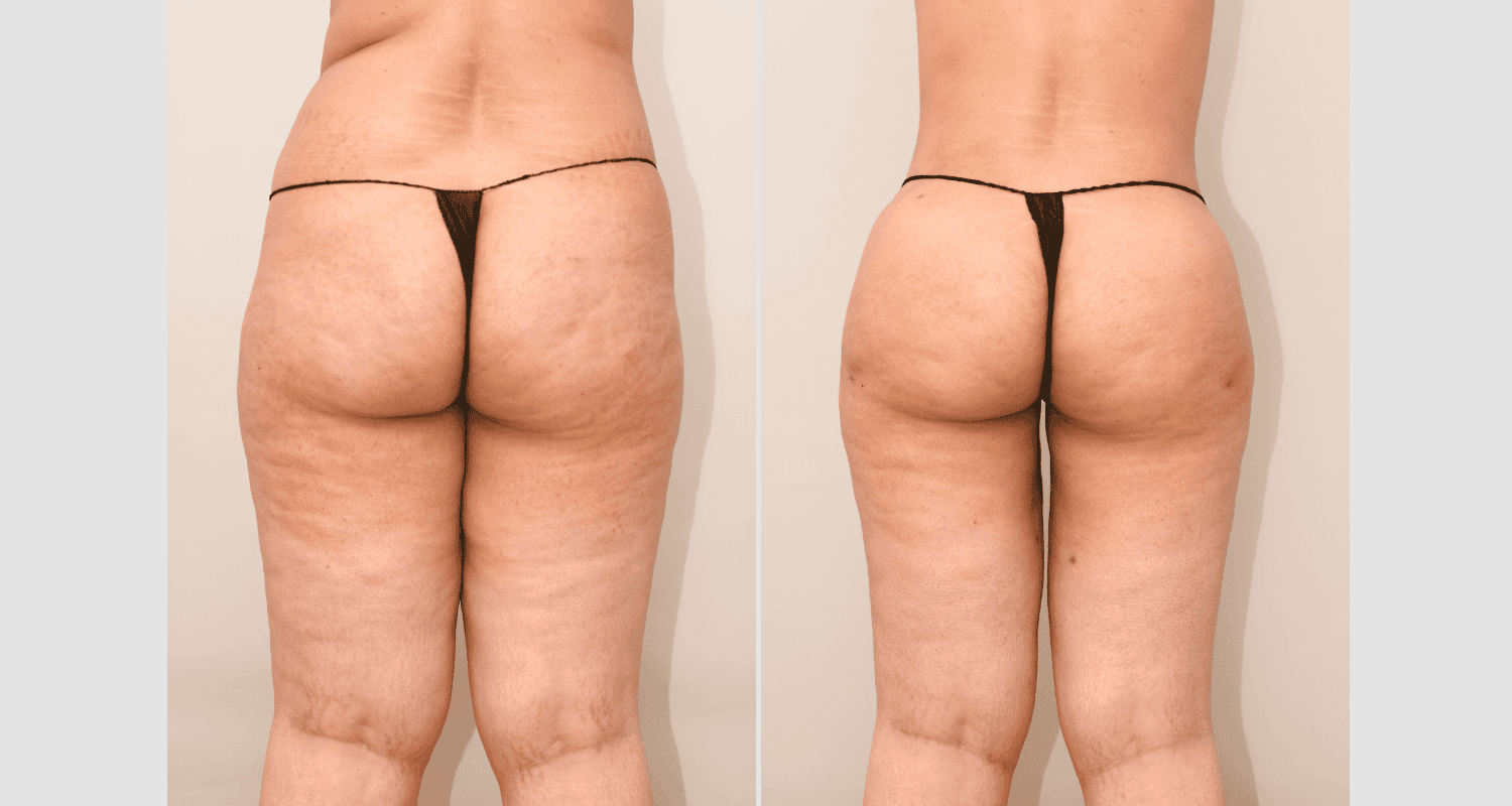 Vorher/Nachher Ergebnis: Eigenfett Bodyforming