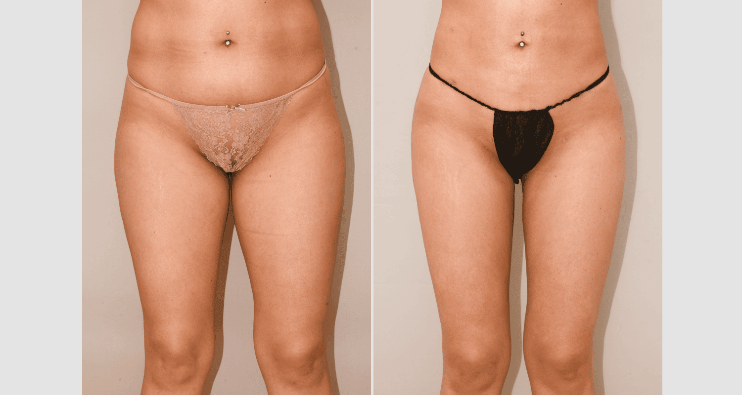 Vorher/Nachher Ergebnis: Eigenfett Bodyforming