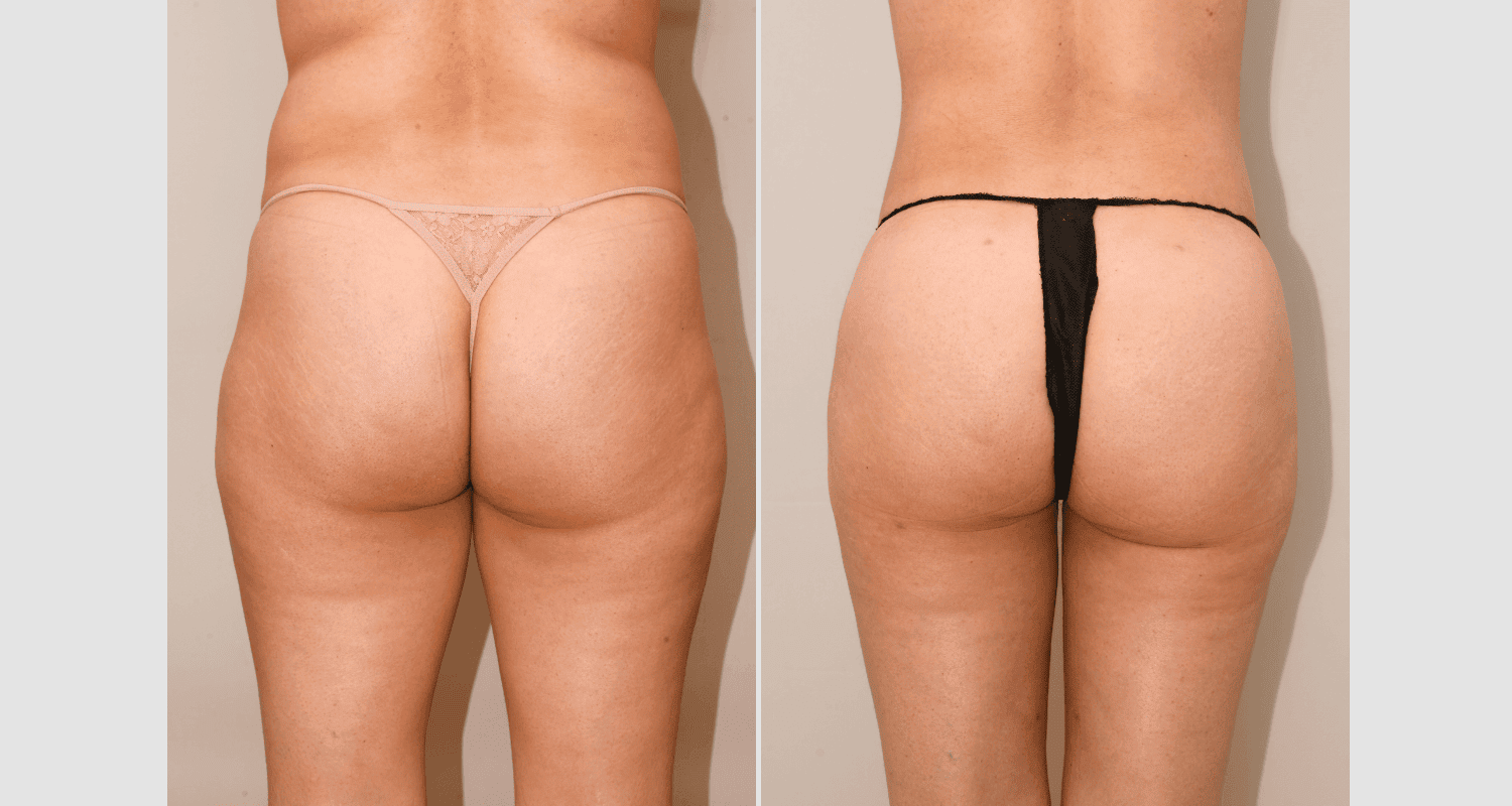 Vorher/Nachher Ergebnis: Eigenfett Bodyforming