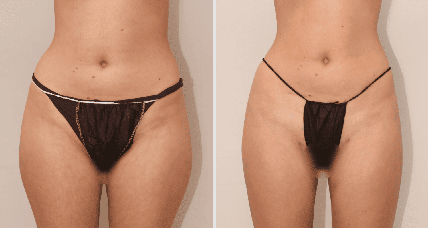Vorher/Nachher Ergebnis: Eigenfett Bodyforming
