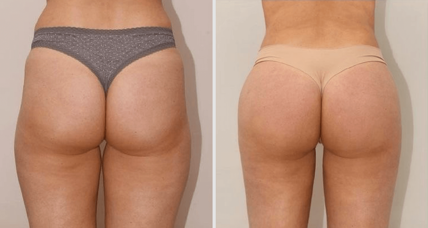 Vorher/Nachher Ergebnis: Eigenfett Bodyforming