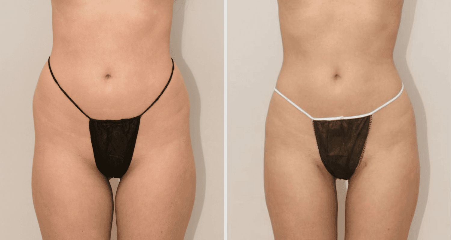 Vorher/Nachher Ergebnis: Eigenfett Bodyforming