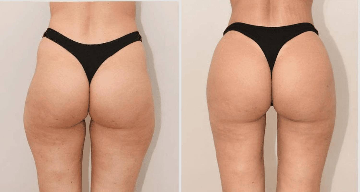 Vorher/Nachher Ergebnis: Eigenfett Bodyforming