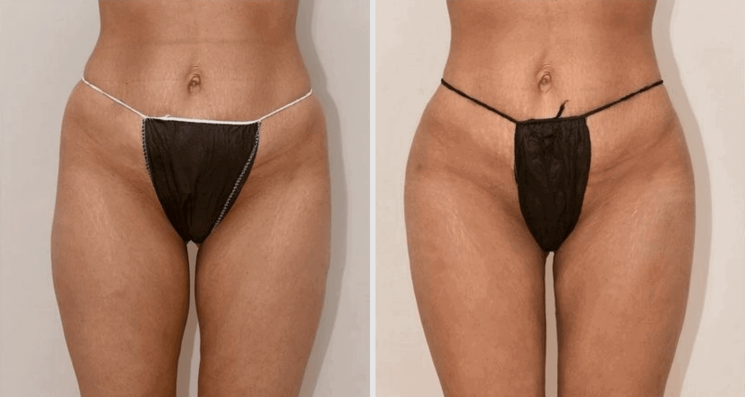 Vorher/Nachher Ergebnis: Eigenfett Bodyforming