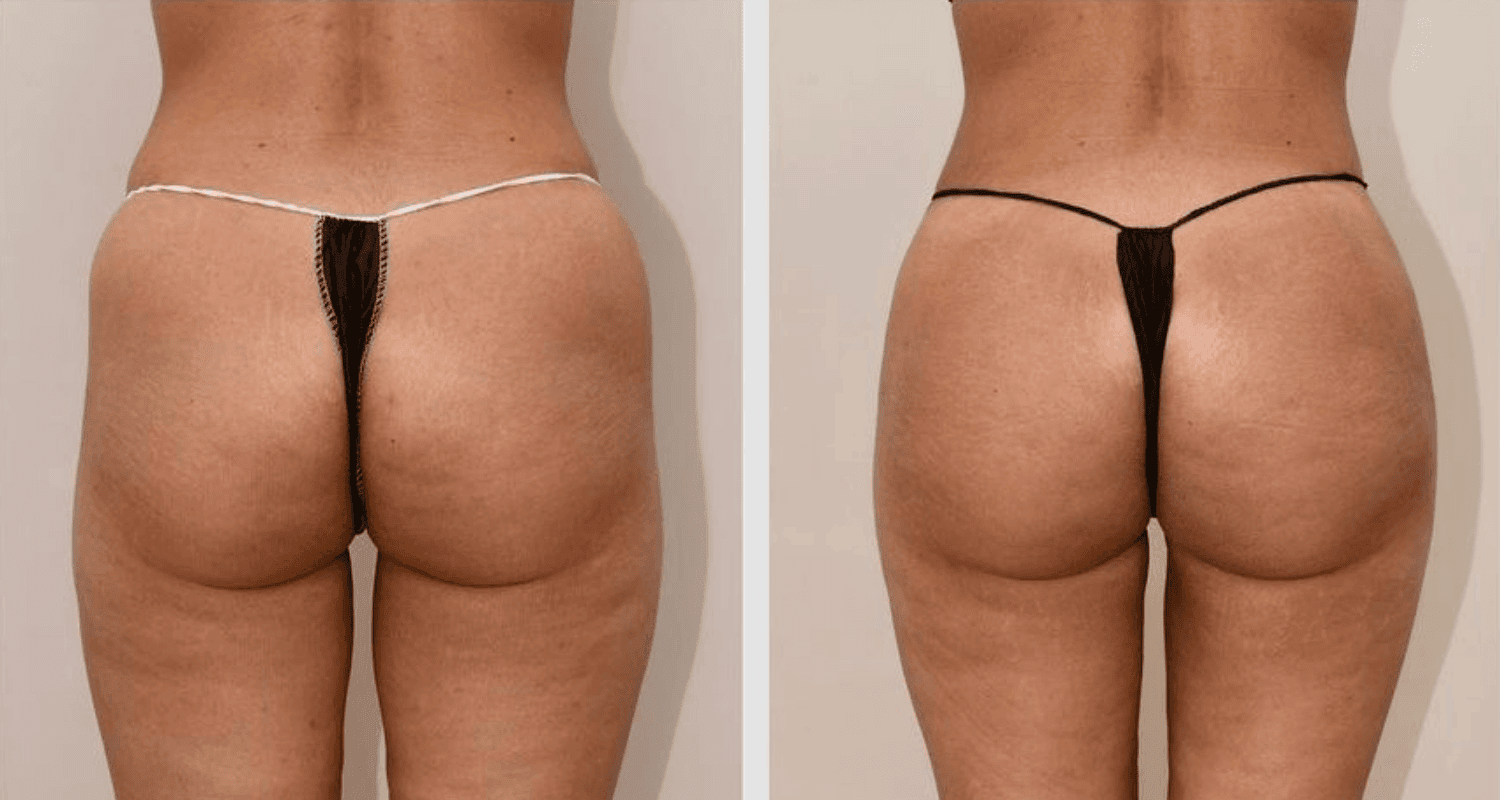 Vorher/Nachher Ergebnis: Eigenfett Bodyforming