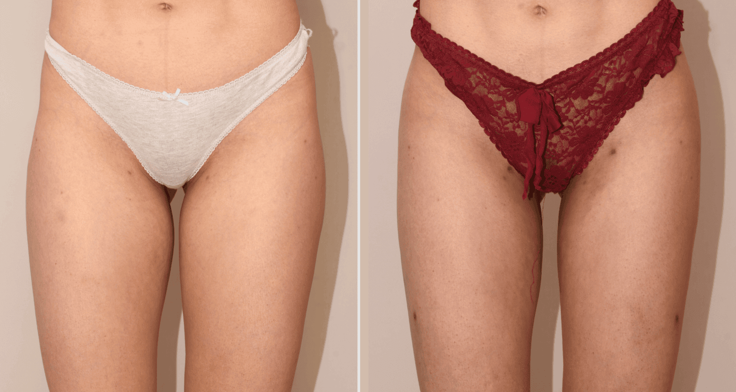 Vorher/Nachher Ergebnis: Eigenfett Bodyforming