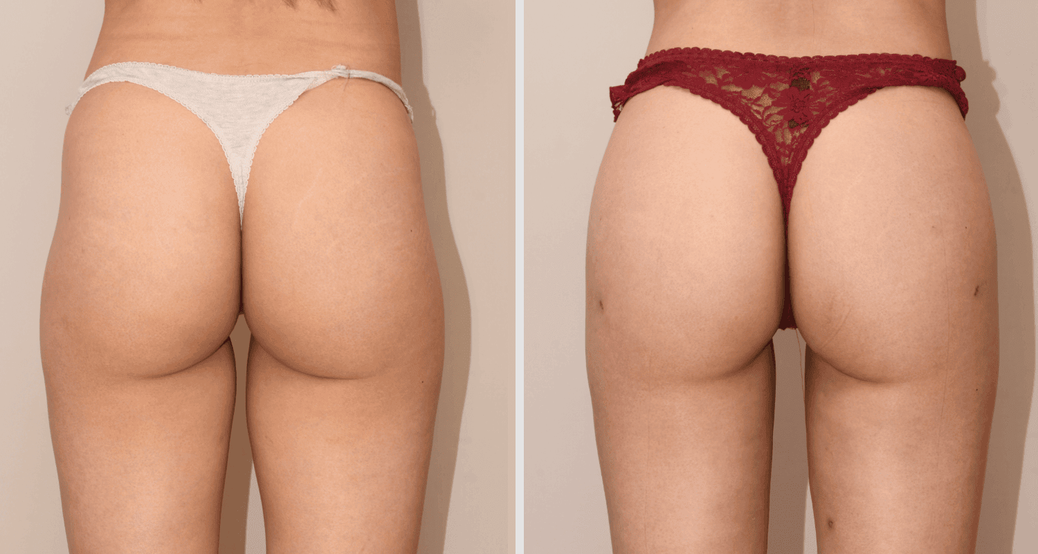 Vorher/Nachher Ergebnis: Eigenfett Bodyforming