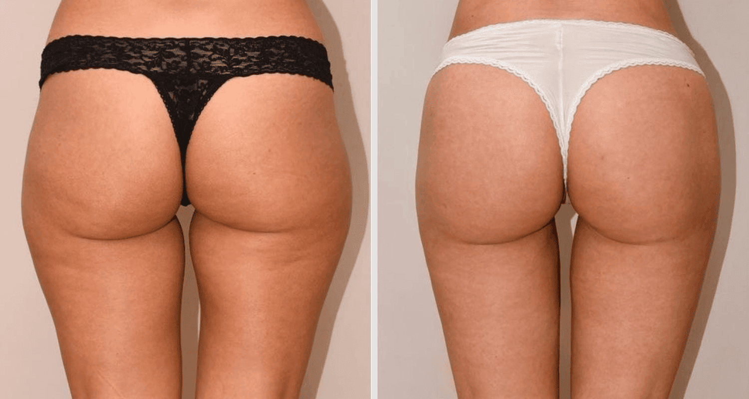 Vorher/Nachher Ergebnis: Eigenfett Bodyforming