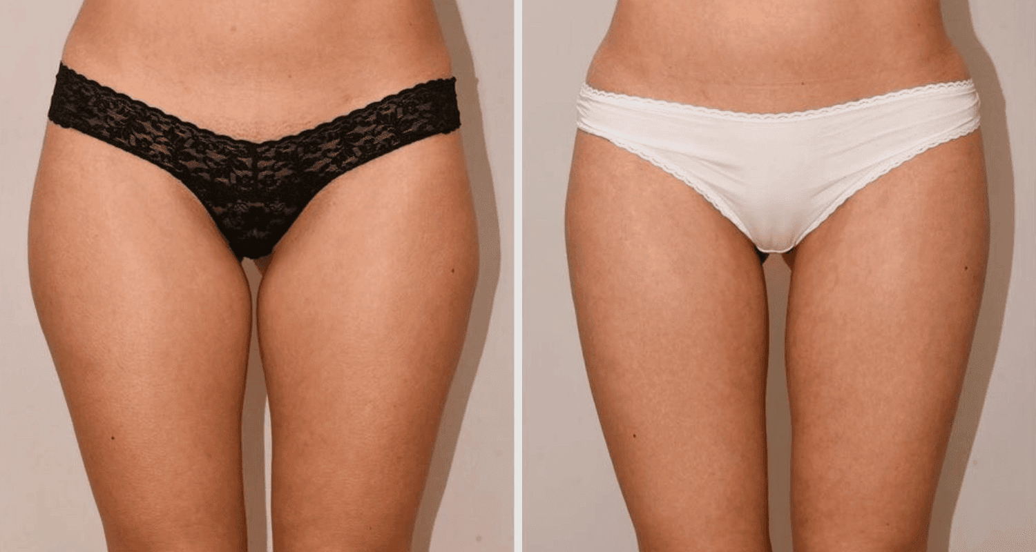 Vorher/Nachher Ergebnis: Eigenfett Bodyforming