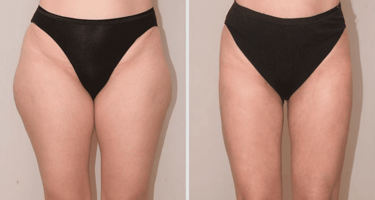Vorher/Nachher Ergebnis: Eigenfett Bodyforming