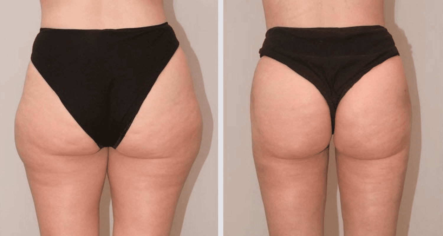 Vorher/Nachher Ergebnis: Eigenfett Bodyforming