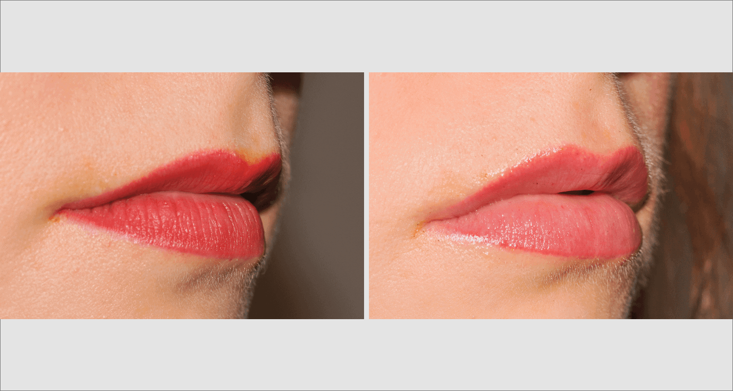 Vorher/Nachher Ergebnis: Eigenfett Lippen